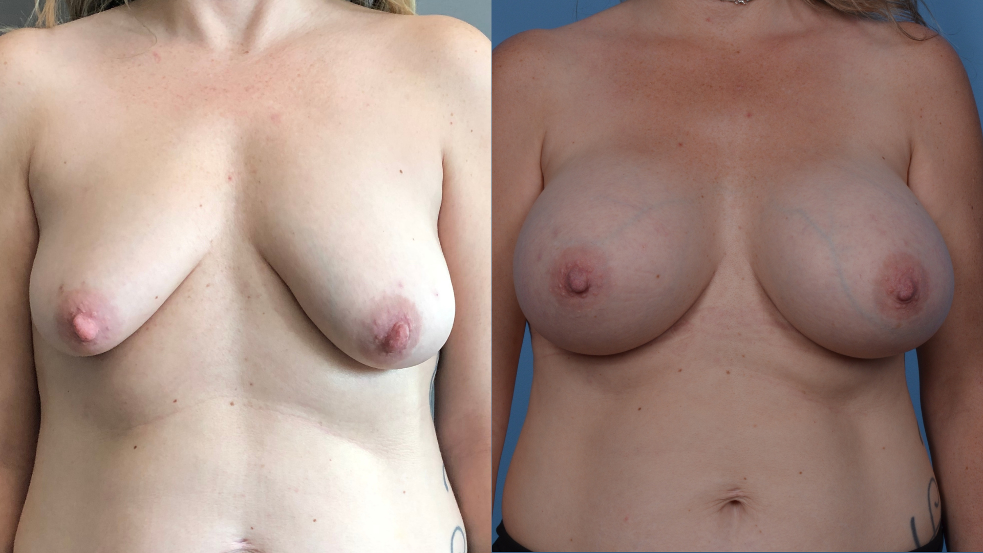 Dr. Asaad Samra Breast Augmentation Before & After 7483
