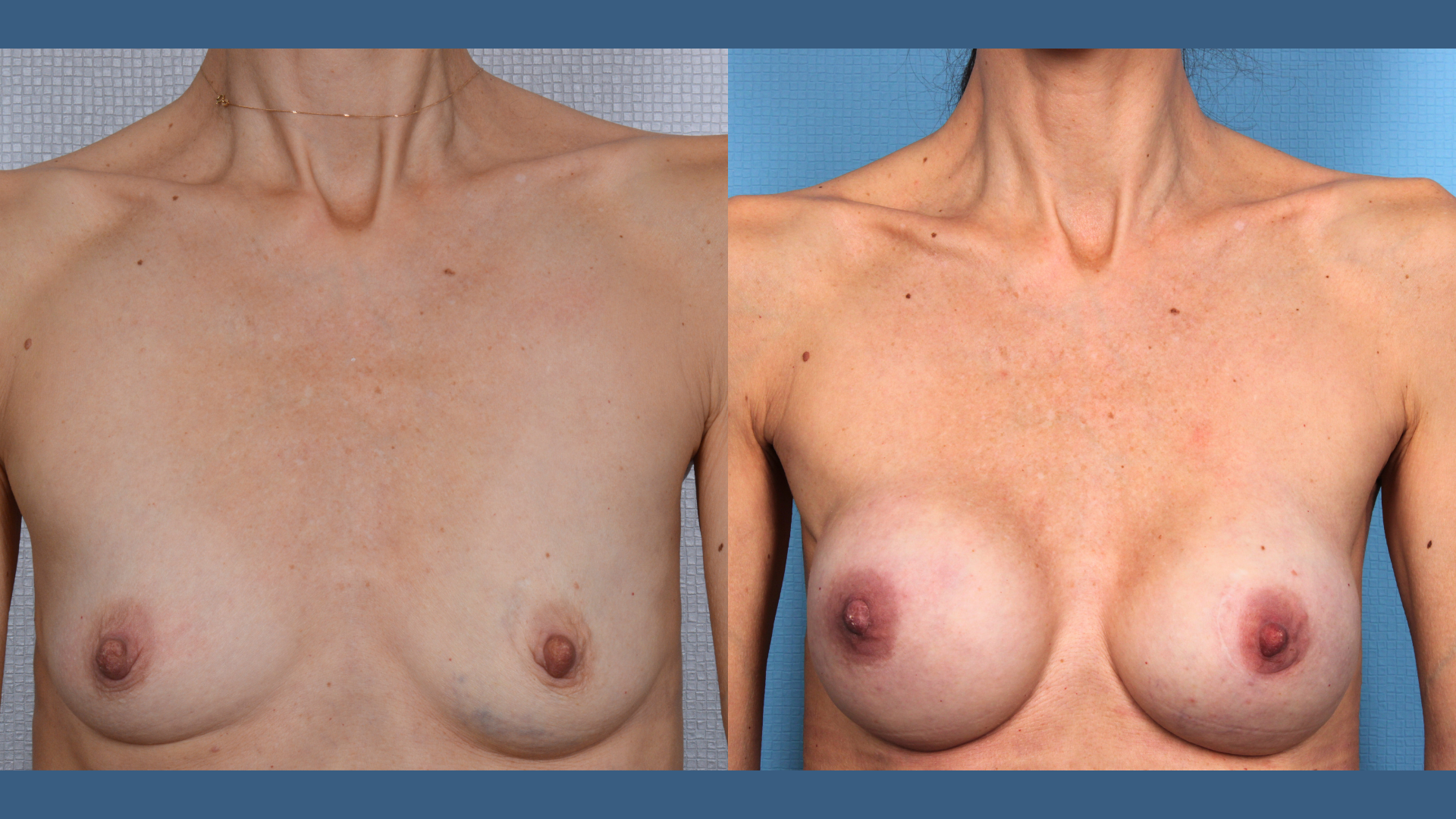 case #6454 implant-based breast reconstruction performed at Samra Plastic & Reconstructive Surgery
