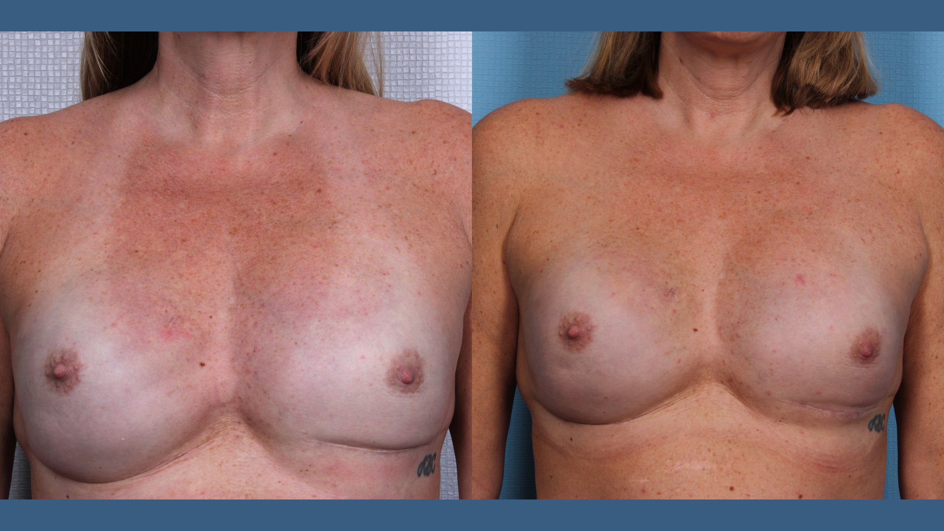 Case 6458 feature photo breast augmentation