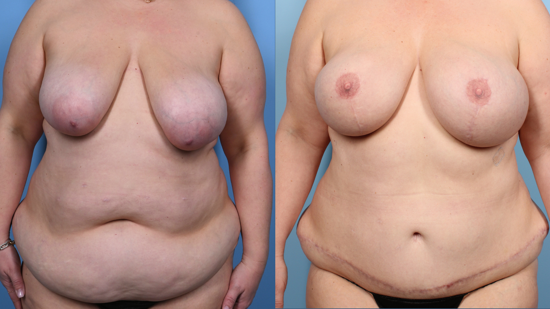 case #6453 autologous-based breast reconstruction at Samra Plastic & Reconstructive Surgery